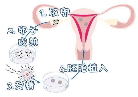無精症
